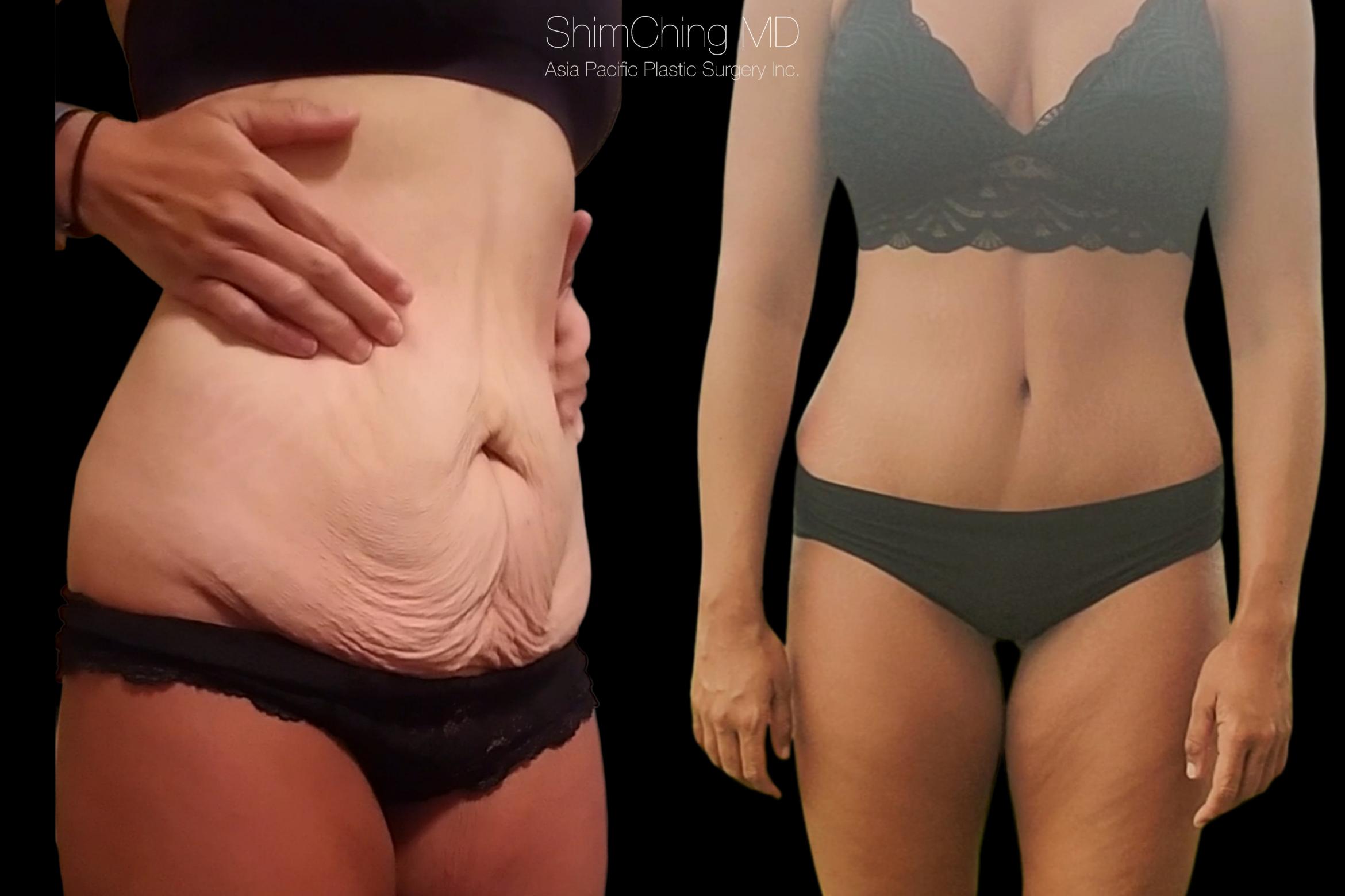 Abdominoplasty Case 303 Before & After Front | Honolulu, HI | Shim Ching, MD: Asia Pacific Plastic Surgery