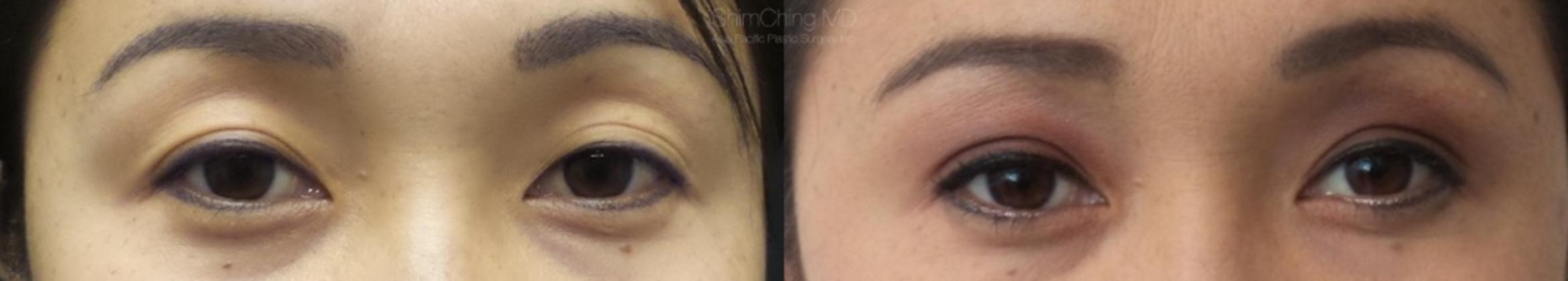 Asian Eyelid Case 13 Before & After View #1 | Honolulu, HI | Shim Ching, MD: Asia Pacific Plastic Surgery