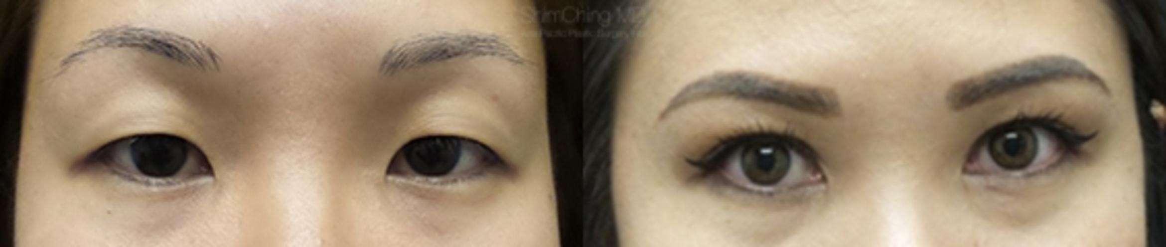 Asian Eyelid Case 153 Before & After View #1 | Honolulu, HI | Shim Ching, MD: Asia Pacific Plastic Surgery