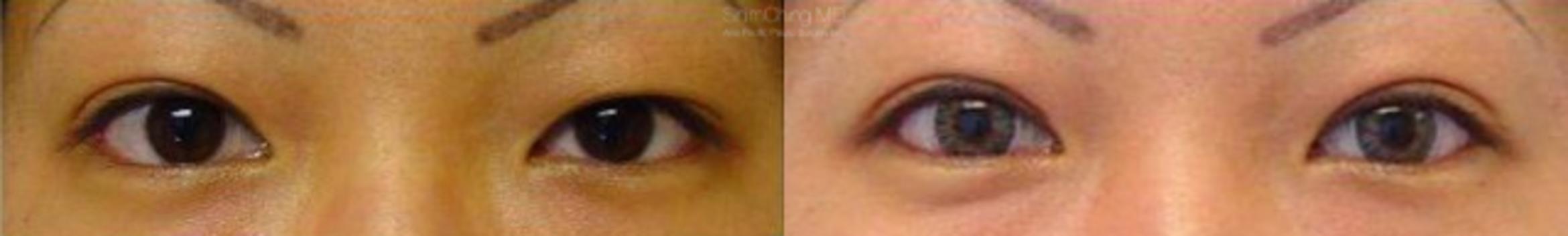 Asian Eyelid Case 195 Before & After View #1 | Honolulu, HI | Shim Ching, MD: Asia Pacific Plastic Surgery