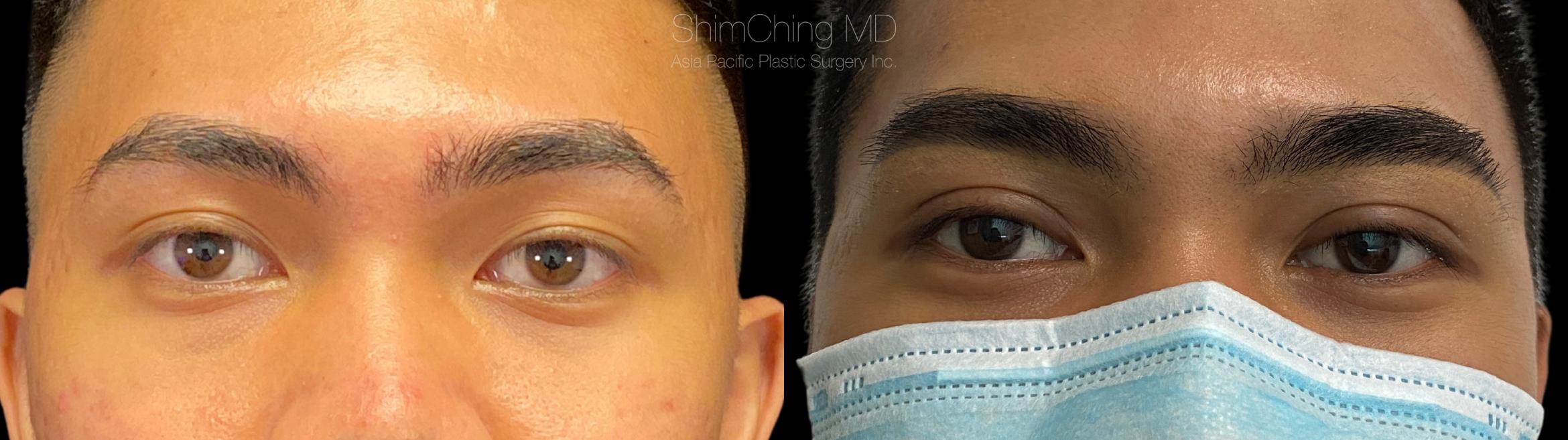 Asian Eyelid Case 277 Before & After Front | Honolulu, HI | Shim Ching, MD: Asia Pacific Plastic Surgery