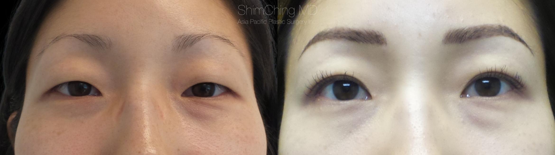Asian Eyelid Case 279 Before & After Front | Honolulu, HI | Shim Ching, MD: Asia Pacific Plastic Surgery