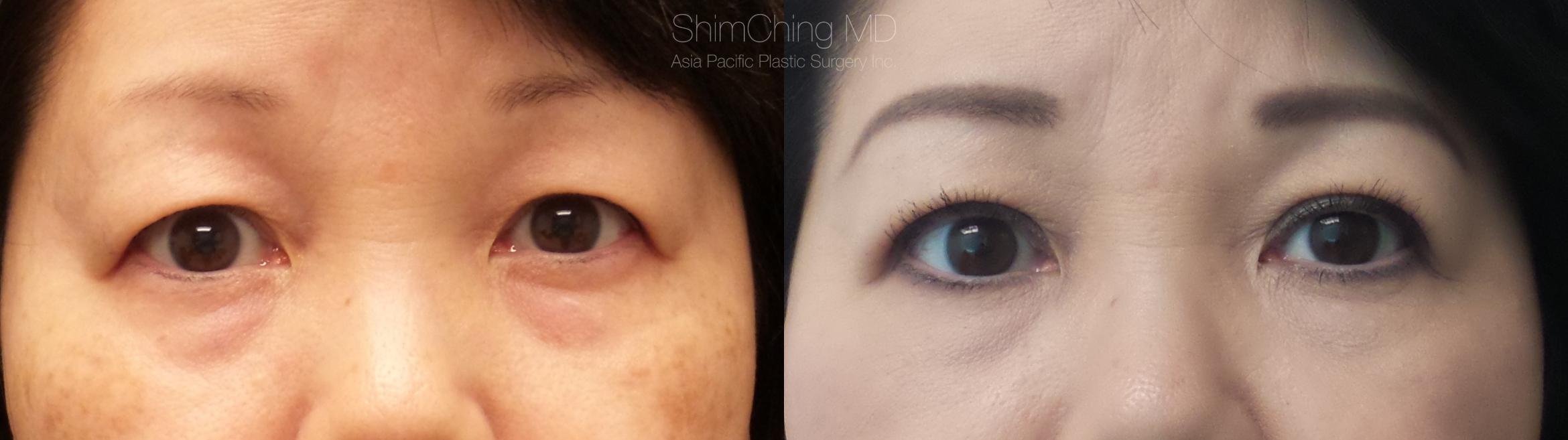 Asian Eyelid Case 282 Before & After Front | Honolulu, HI | Shim Ching, MD: Asia Pacific Plastic Surgery