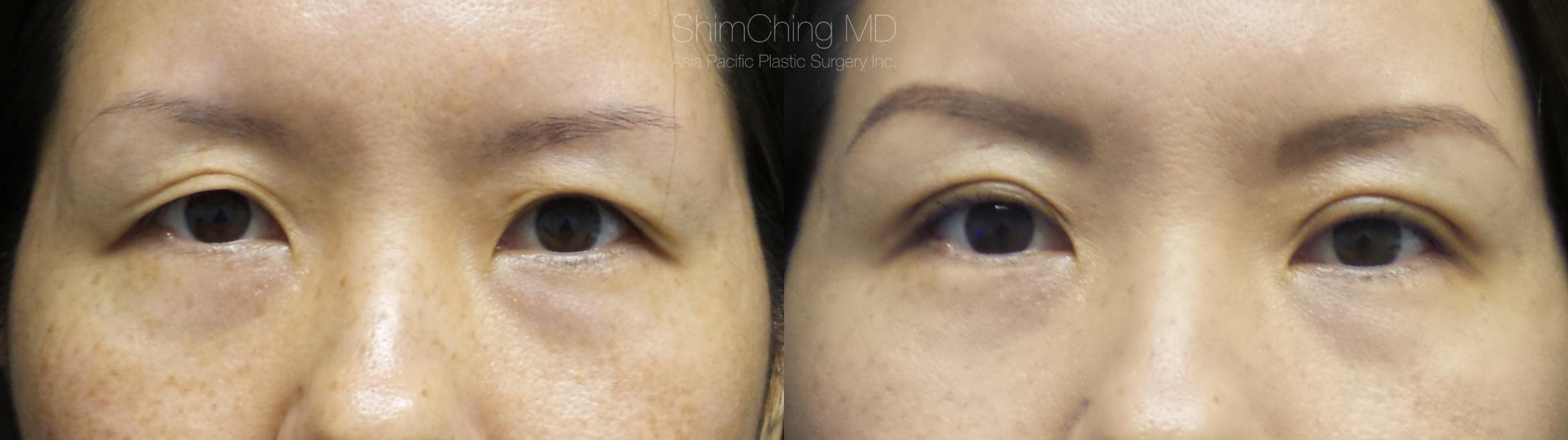 Asian Eyelid Case 285 Before & After Front | Honolulu, HI | Shim Ching, MD: Asia Pacific Plastic Surgery