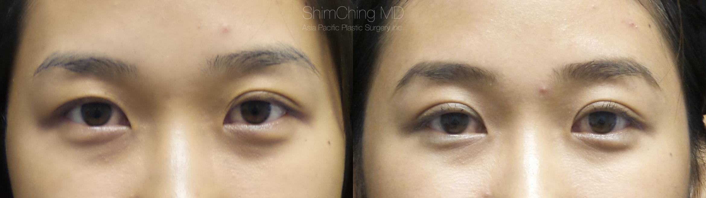 Asian Eyelid Case 286 Before & After Front | Honolulu, HI | Shim Ching, MD: Asia Pacific Plastic Surgery