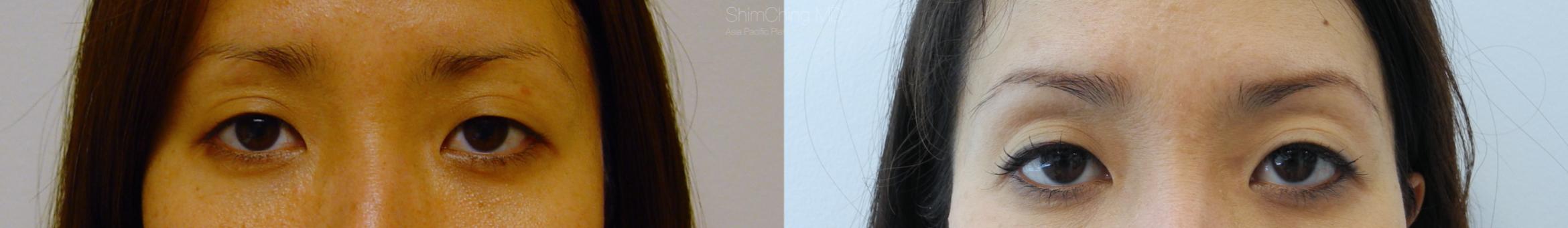Asian Eyelid Case 7 Before & After View #1 | Honolulu, HI | Shim Ching, MD: Asia Pacific Plastic Surgery