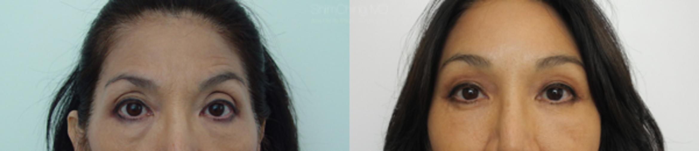 Asian Eyelid Case 8 Before & After View #1 | Honolulu, HI | Shim Ching, MD: Asia Pacific Plastic Surgery