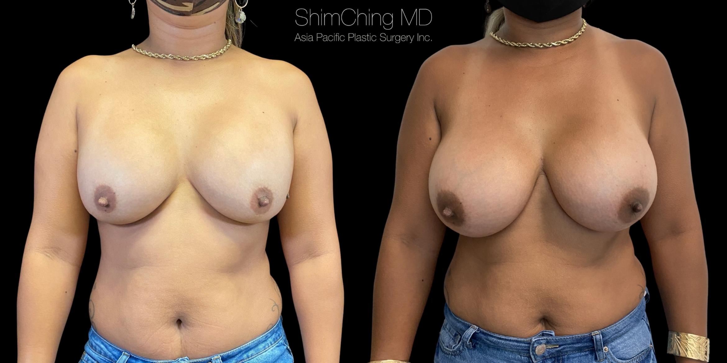 Breast Augmentation Revision Case 348 Before & After Front | Honolulu, HI | Shim Ching, MD: Asia Pacific Plastic Surgery