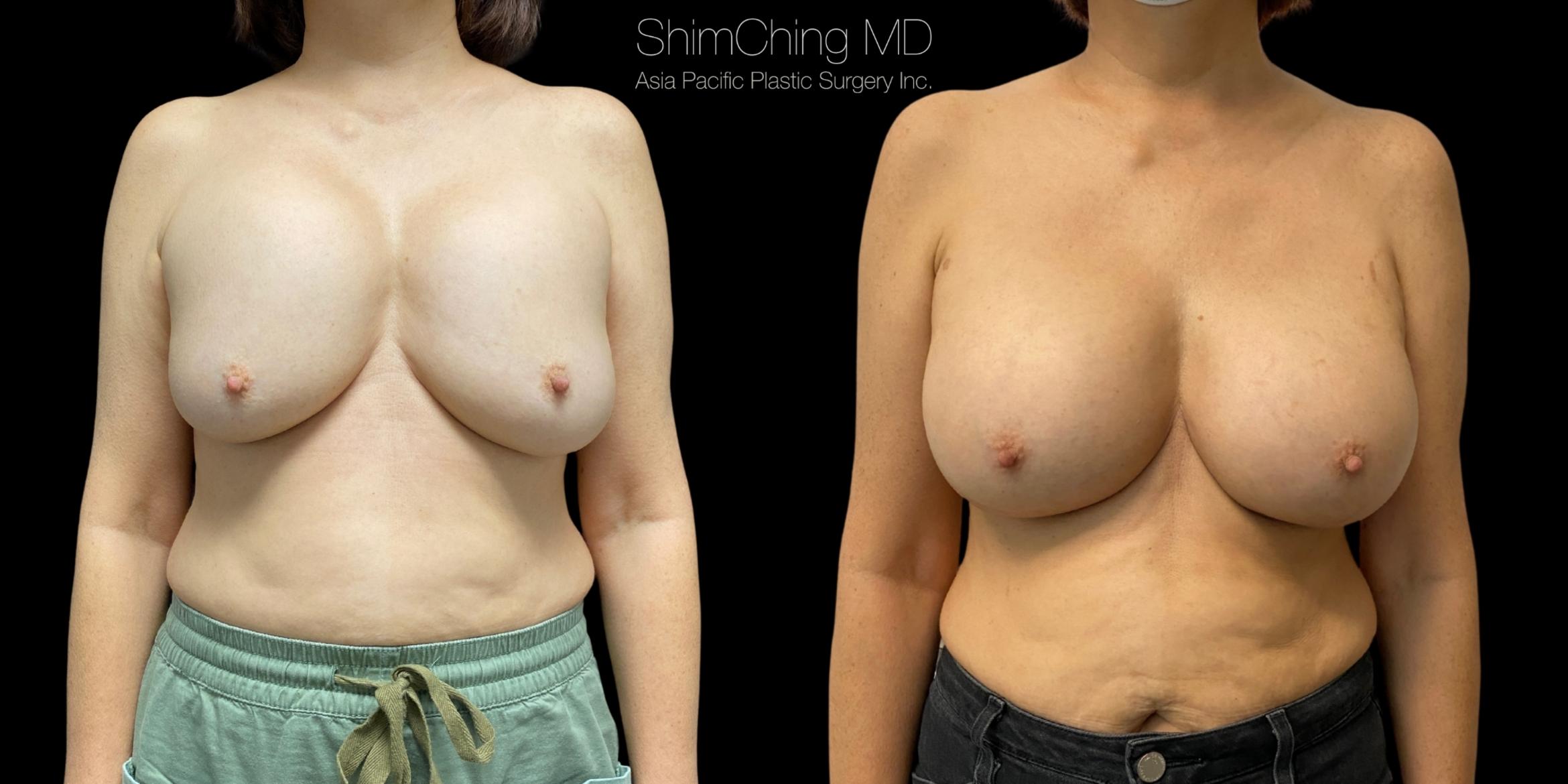 Breast Augmentation Revision Case 349 Before & After Front | Honolulu, HI | Shim Ching, MD: Asia Pacific Plastic Surgery