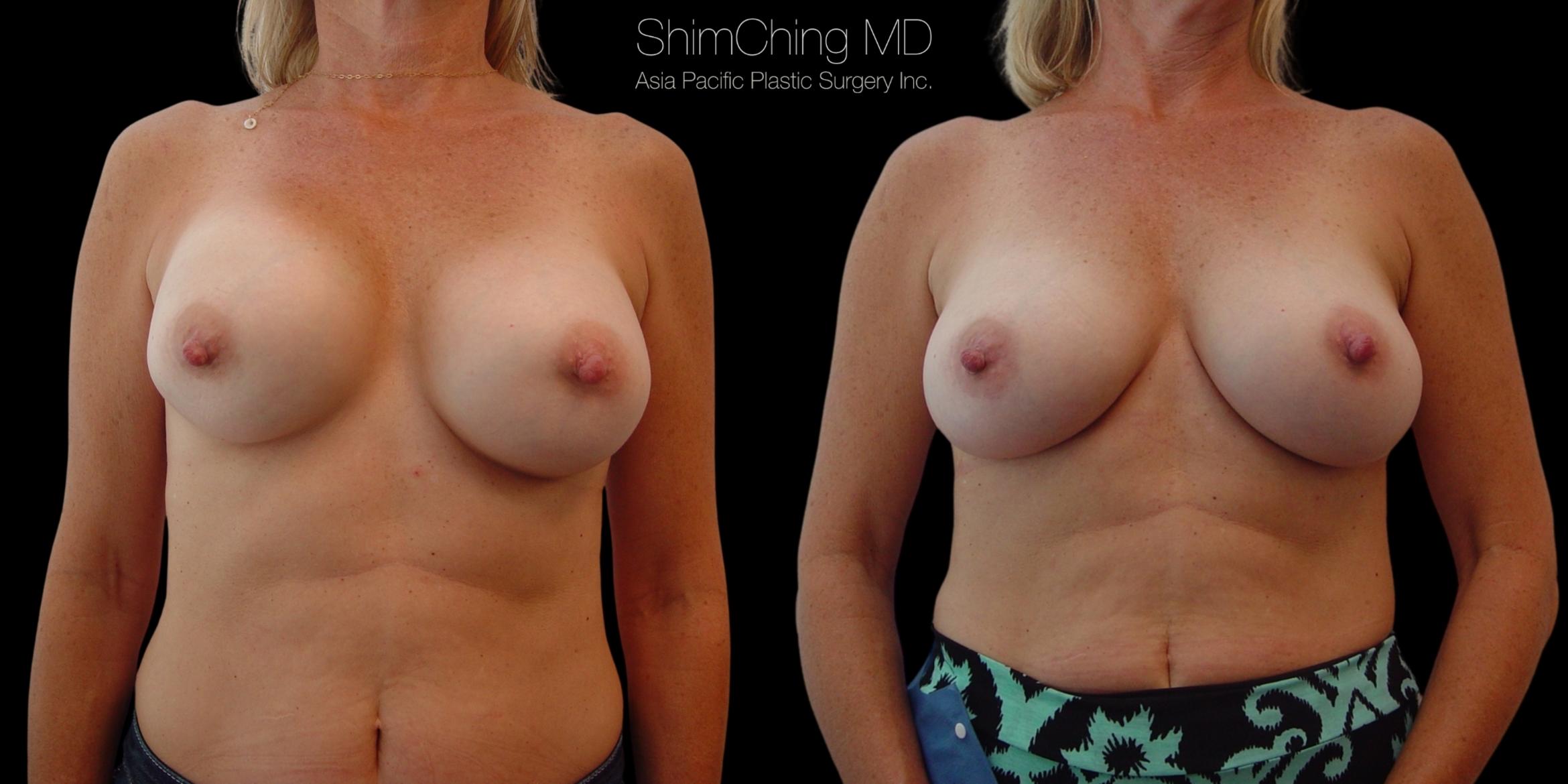 Breast Augmentation Revision Case 84 Before & After Front | Honolulu, HI | Shim Ching, MD: Asia Pacific Plastic Surgery