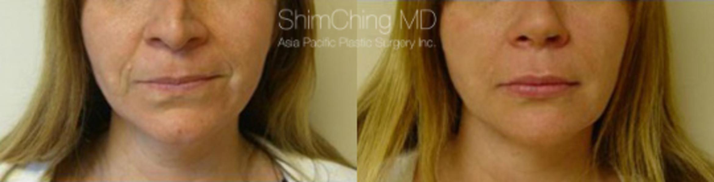 Chin Case 16 Before & After View #1 | Honolulu, HI | Shim Ching, MD: Asia Pacific Plastic Surgery