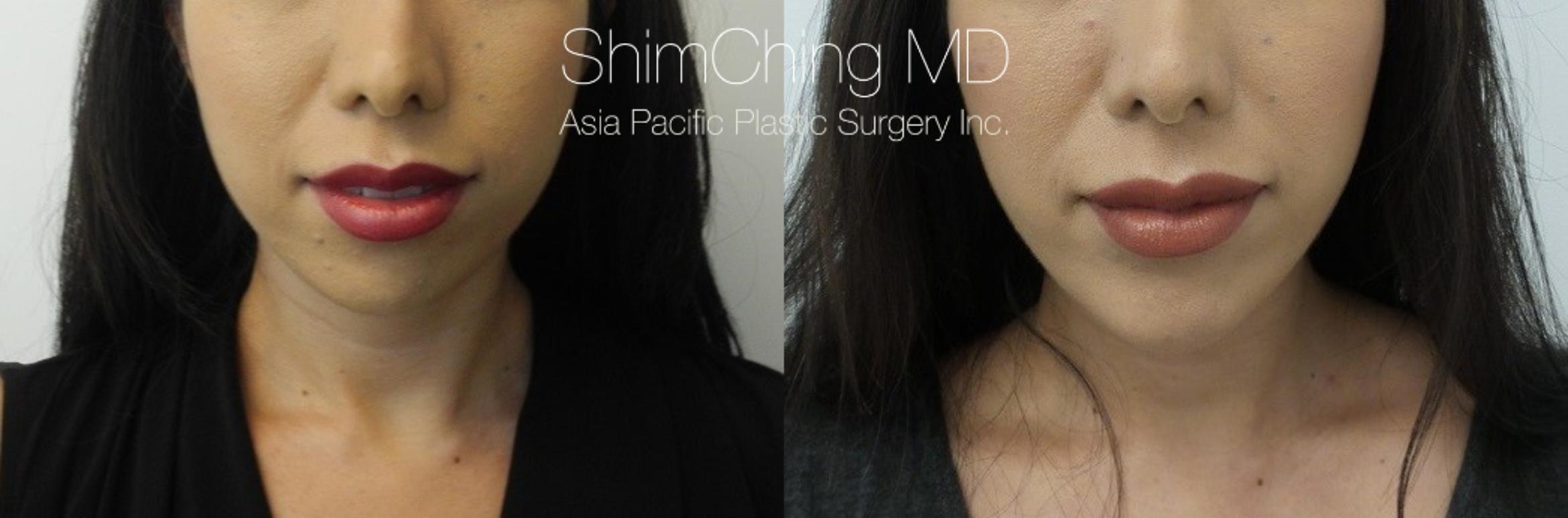 Chin Case 17 Before & After View #1 | Honolulu, HI | Shim Ching, MD: Asia Pacific Plastic Surgery