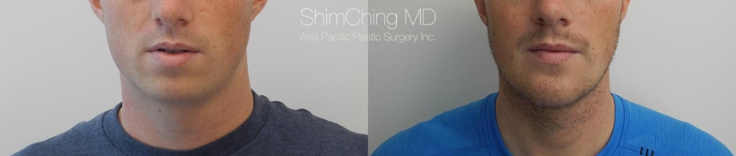 Chin Case 18 Before & After View #1 | Honolulu, HI | Shim Ching, MD: Asia Pacific Plastic Surgery