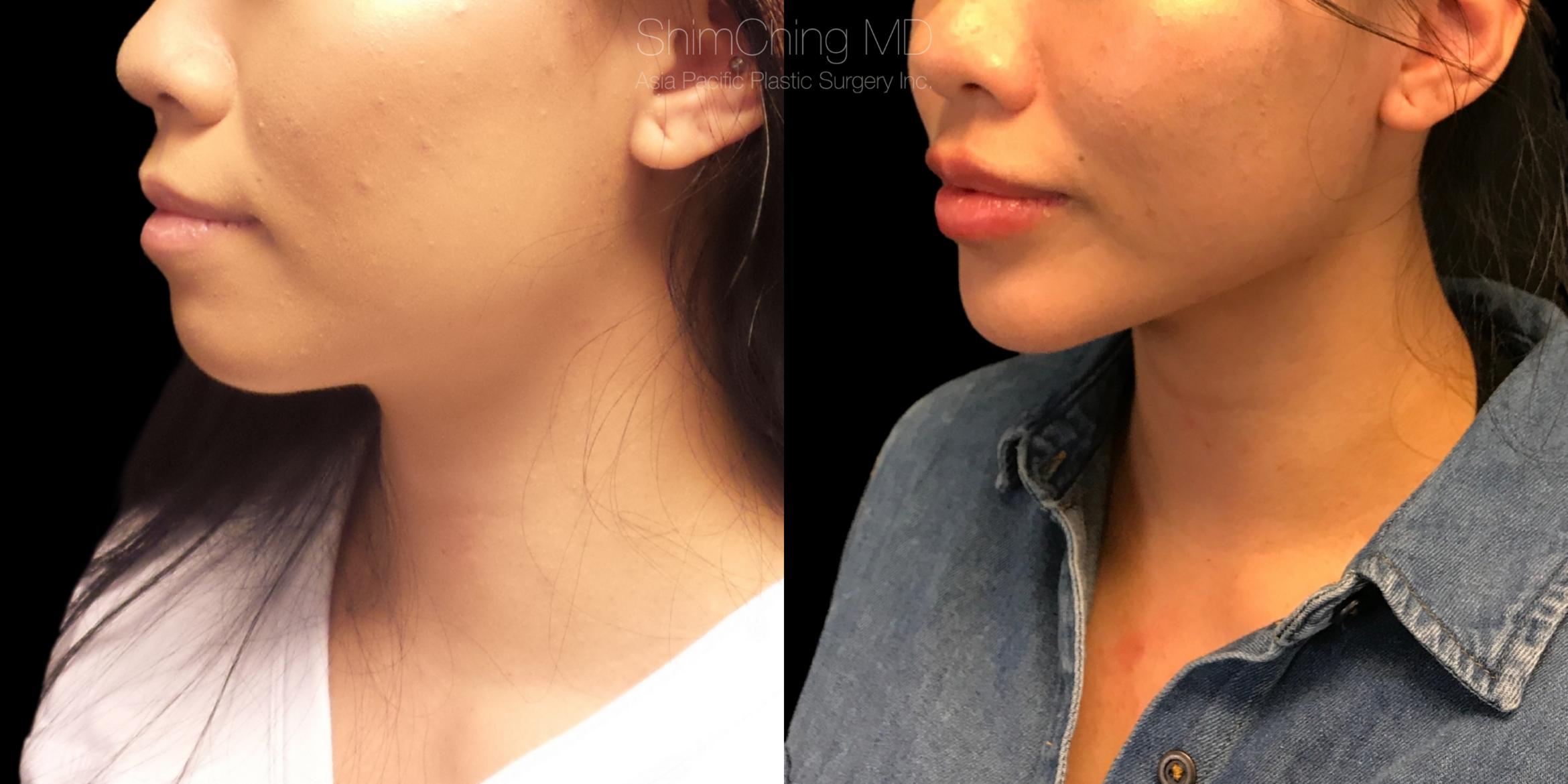 Chin Case 319 Before & After Right Oblique | Honolulu, HI | Shim Ching, MD: Asia Pacific Plastic Surgery