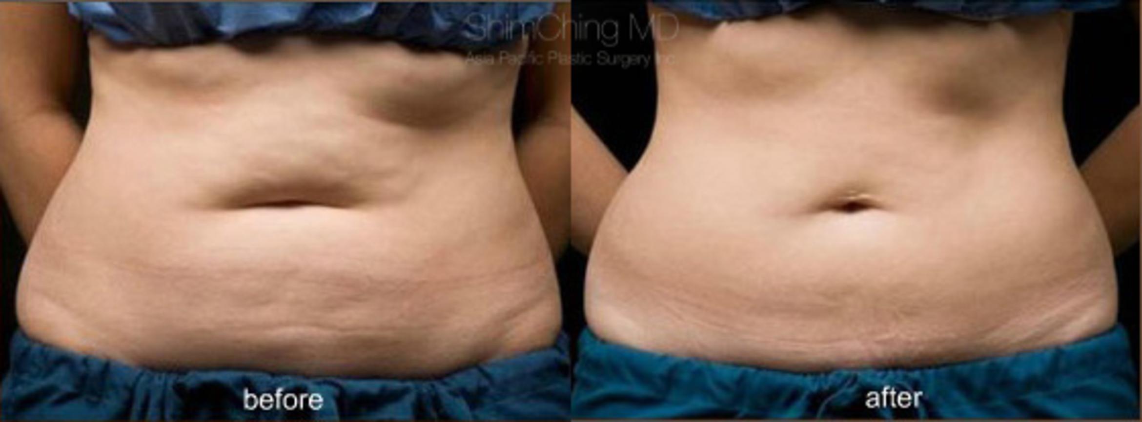 CoolSculpting Case 103 Before & After View #1 | Honolulu, HI | Shim Ching, MD: Asia Pacific Plastic Surgery