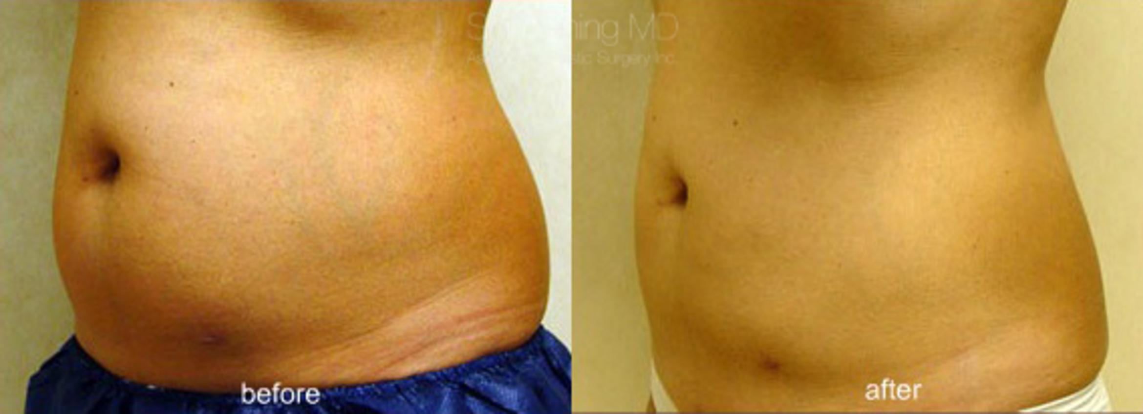 CoolSculpting Case 107 Before & After View #1 | Honolulu, HI | Shim Ching, MD: Asia Pacific Plastic Surgery