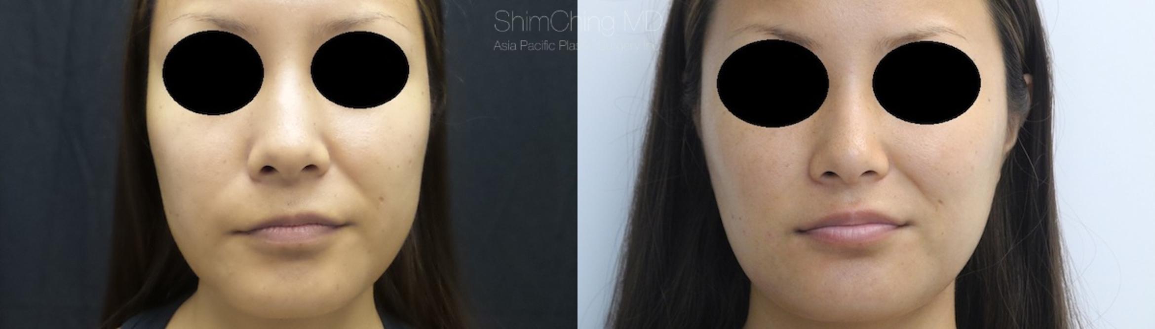 Facial Cosmetic Surgery Case 115 Before & After View #1 | Honolulu, HI | Shim Ching, MD: Asia Pacific Plastic Surgery