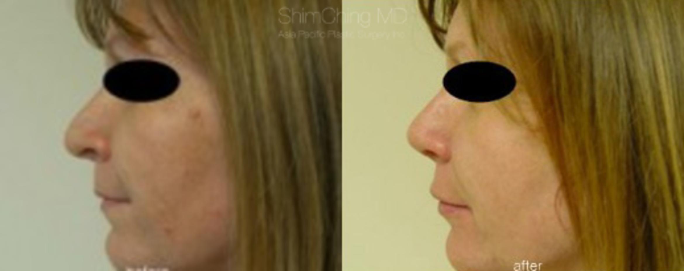 Facial Cosmetic Surgery Case 193 Before & After View #1 | Honolulu, HI | Shim Ching, MD: Asia Pacific Plastic Surgery