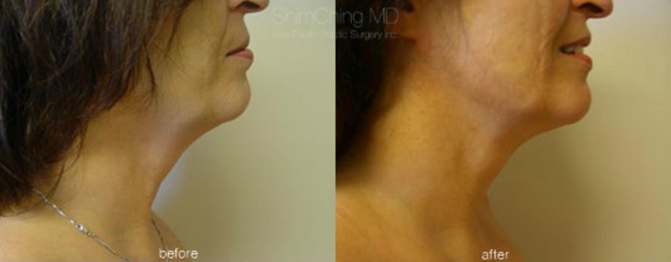 Facial Cosmetic Surgery Case 194 Before & After View #1 | Honolulu, HI | Shim Ching, MD: Asia Pacific Plastic Surgery