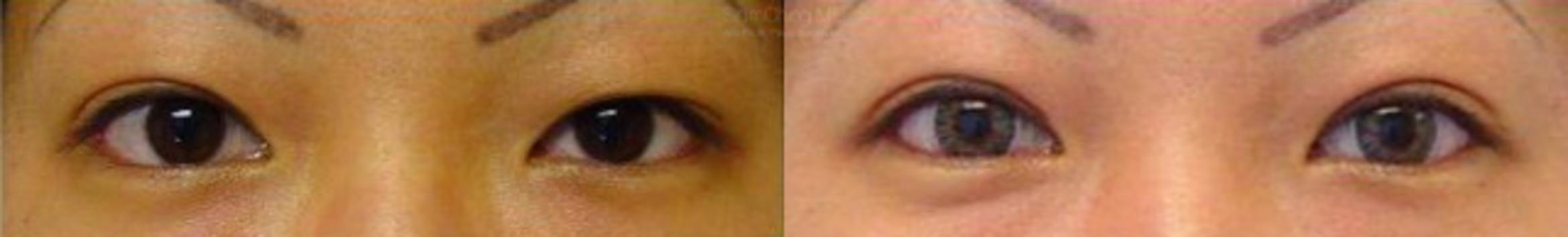 Facial Cosmetic Surgery Case 195 Before & After View #1 | Honolulu, HI | Shim Ching, MD: Asia Pacific Plastic Surgery