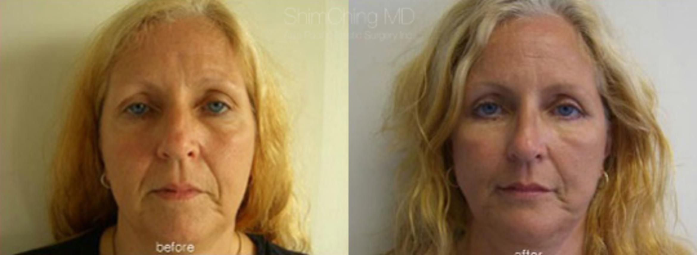 Facial Cosmetic Surgery Case 196 Before & After View #1 | Honolulu, HI | Shim Ching, MD: Asia Pacific Plastic Surgery