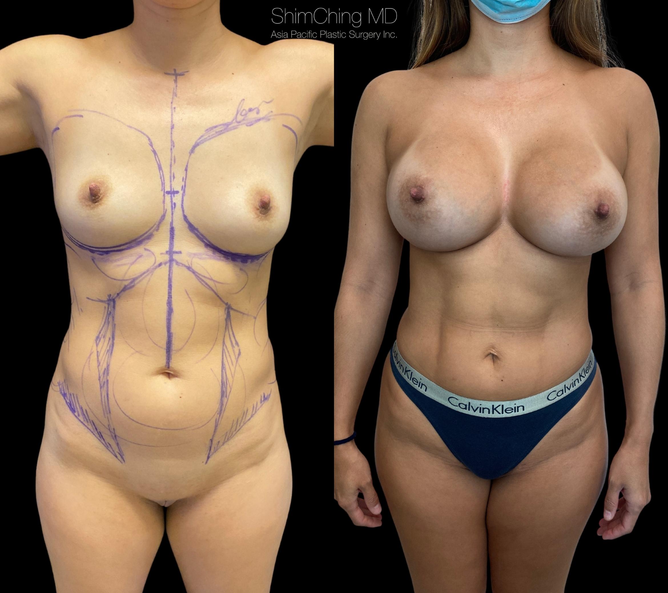 HiDefinition Liposuction Case 324 Before & After Front | Honolulu, HI | Shim Ching, MD: Asia Pacific Plastic Surgery