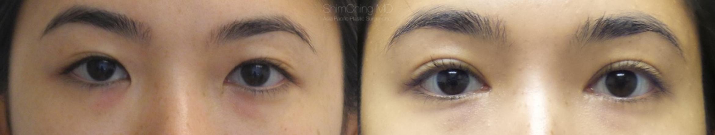 Homepage Featured Cases Case 164 Before & After View #1 | Honolulu, HI | Shim Ching, MD: Asia Pacific Plastic Surgery