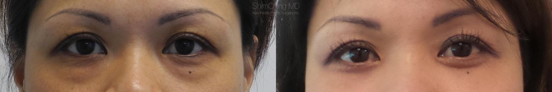 Homepage Featured Cases Case 165 Before & After View #1 | Honolulu, HI | Shim Ching, MD: Asia Pacific Plastic Surgery