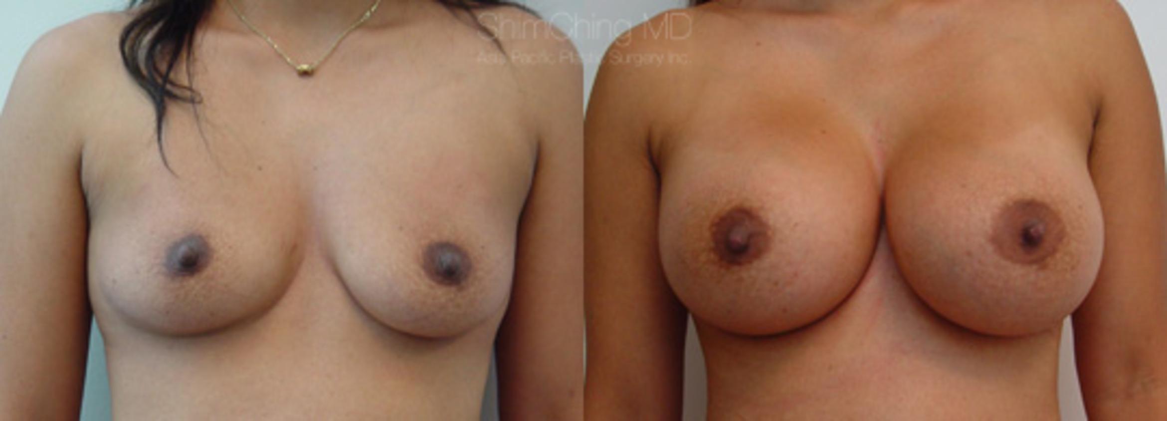 Homepage Featured Cases Case 166 Before & After View #1 | Honolulu, HI | Shim Ching, MD: Asia Pacific Plastic Surgery