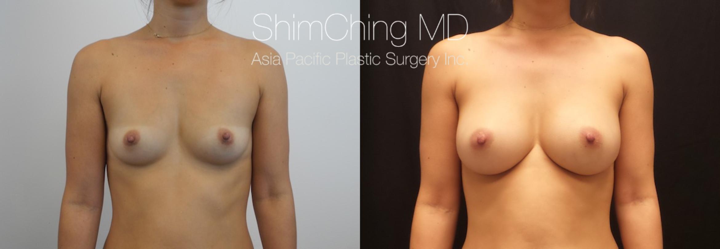 Homepage Featured Cases Case 167 Before & After View #1 | Honolulu, HI | Shim Ching, MD: Asia Pacific Plastic Surgery