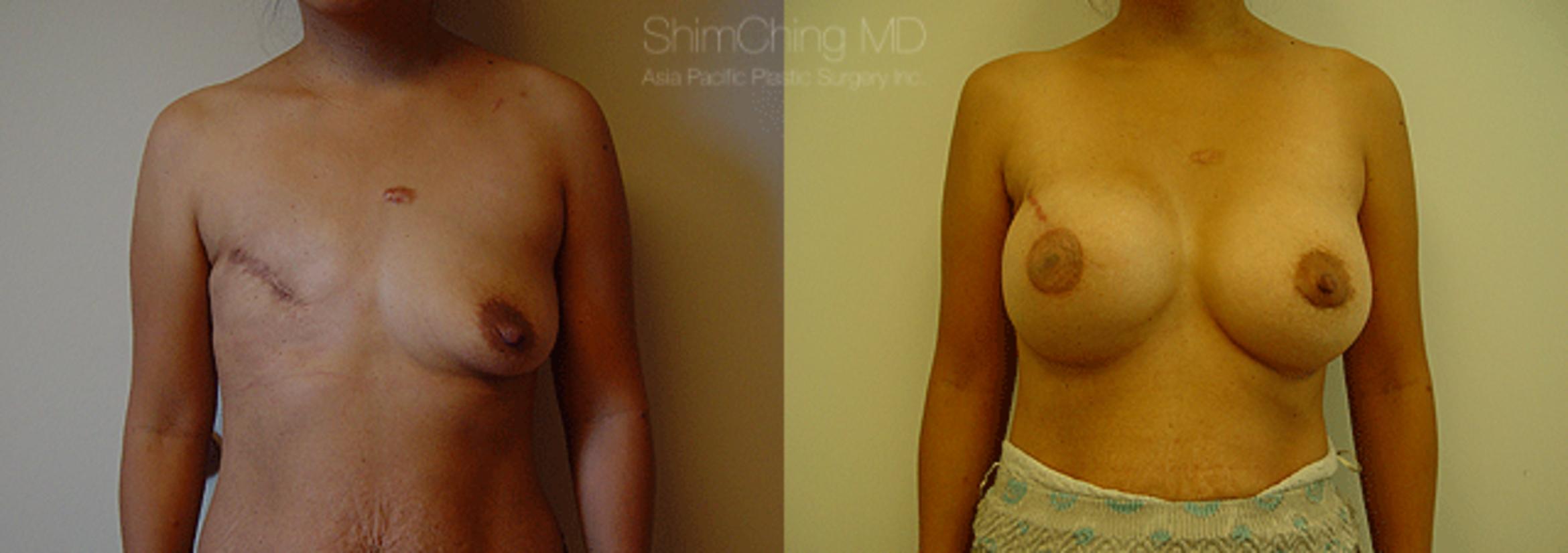 Homepage Featured Cases Case 172 Before & After View #1 | Honolulu, HI | Shim Ching, MD: Asia Pacific Plastic Surgery
