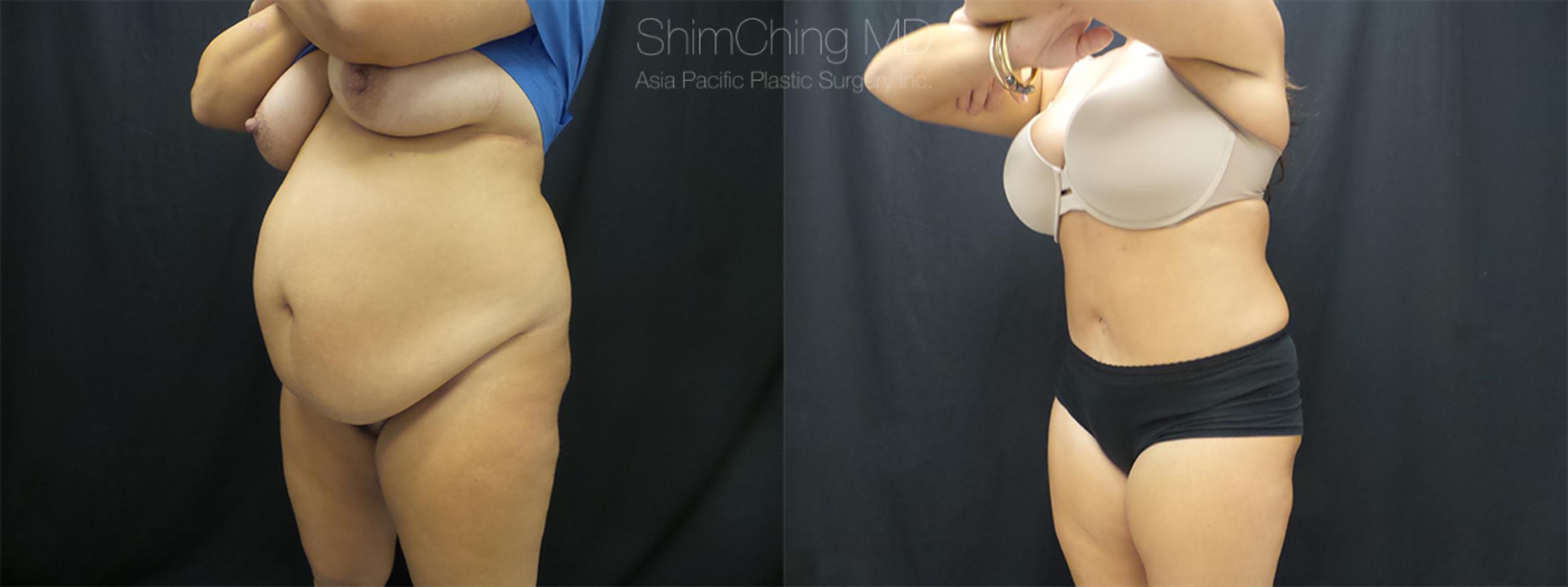 Homepage Featured Cases Case 174 Before & After View #1 | Honolulu, HI | Shim Ching, MD: Asia Pacific Plastic Surgery