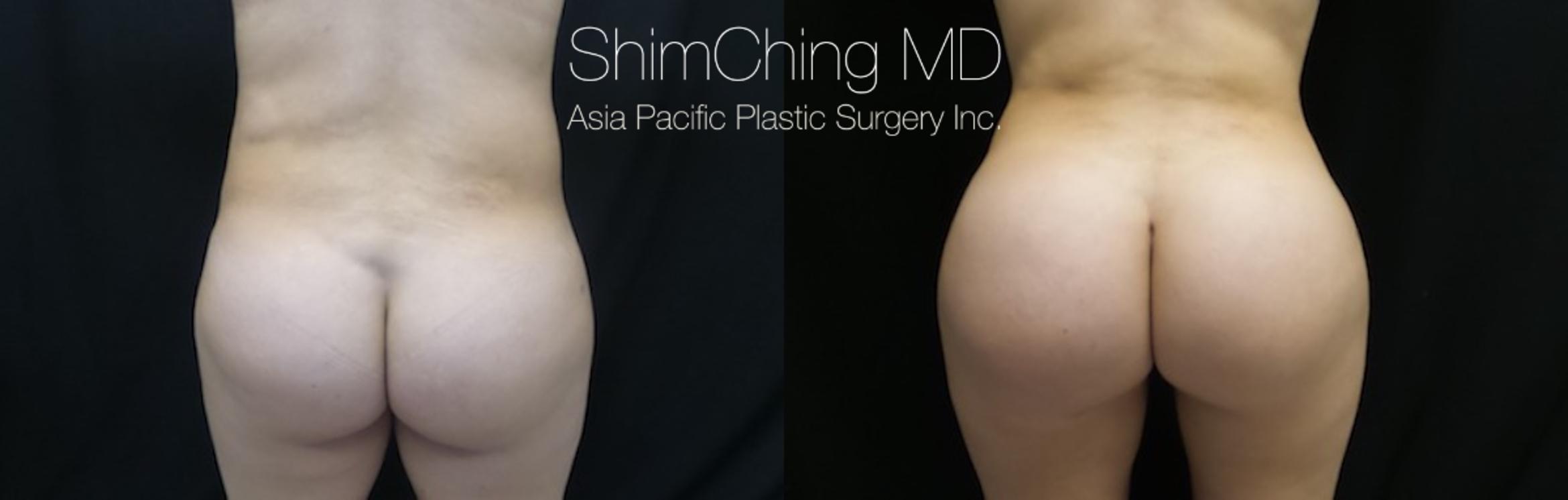 Homepage Featured Cases Case 175 Before & After View #1 | Honolulu, HI | Shim Ching, MD: Asia Pacific Plastic Surgery