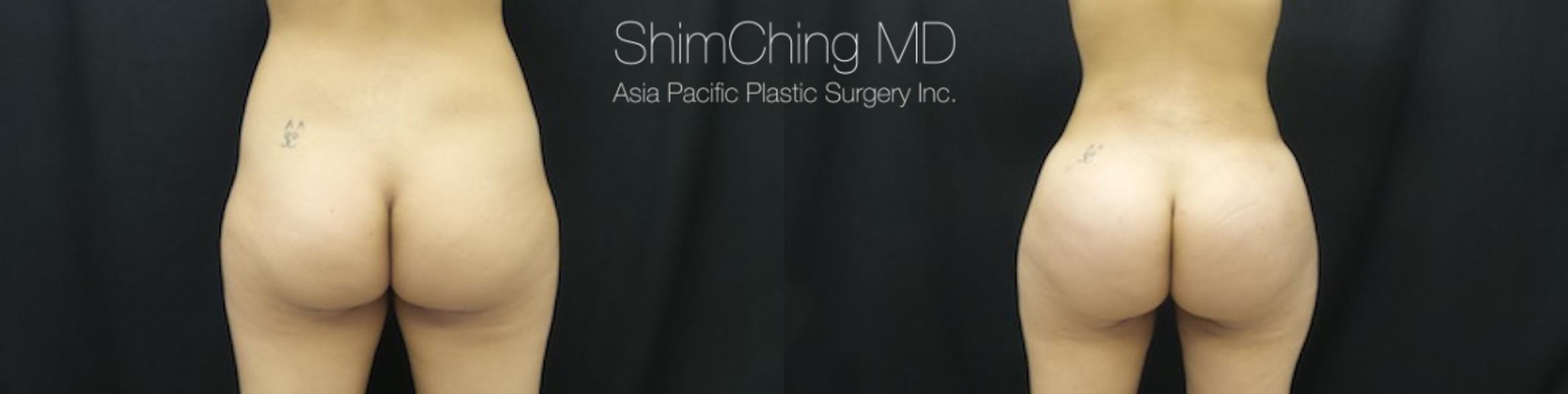 Homepage Featured Cases Case 176 Before & After View #1 | Honolulu, HI | Shim Ching, MD: Asia Pacific Plastic Surgery