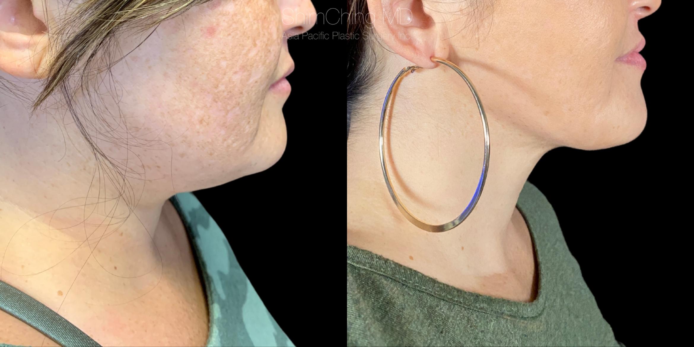Laser Liposuction Case 320 Before & After Right Side | Honolulu, HI | Shim Ching, MD: Asia Pacific Plastic Surgery