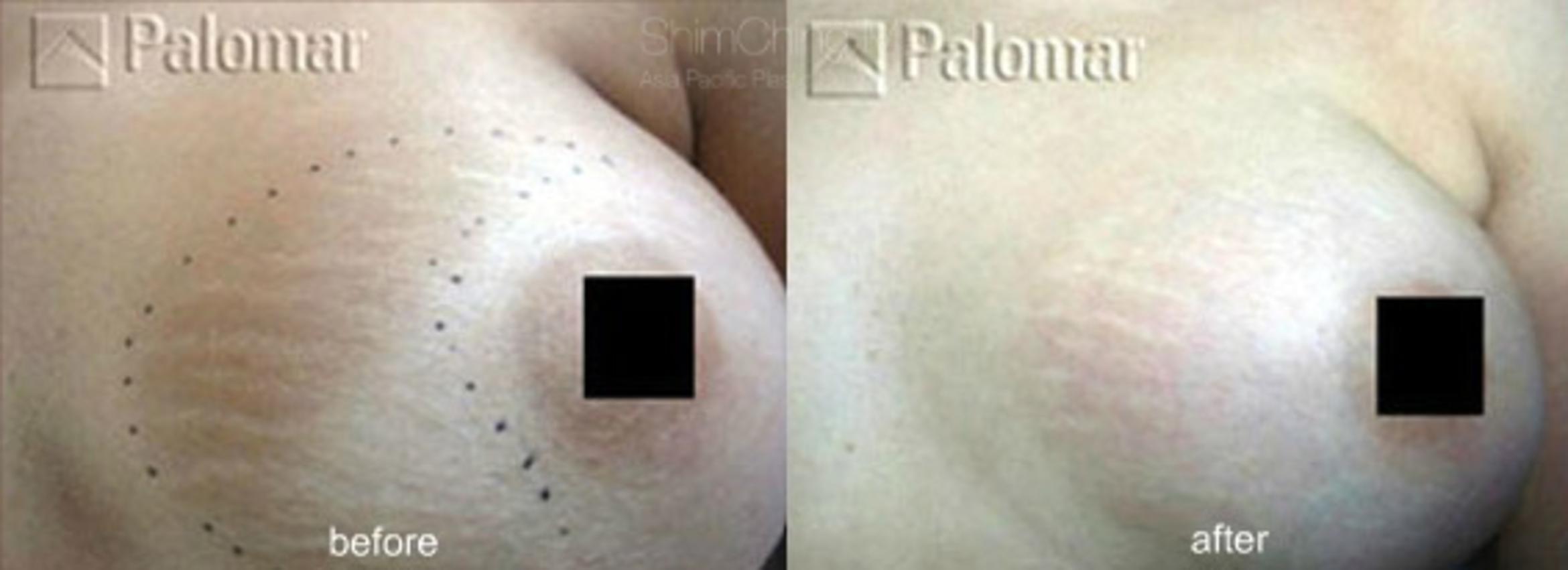Laser Resurfacing Case 138 Before & After View #1 | Honolulu, HI | Shim Ching, MD: Asia Pacific Plastic Surgery