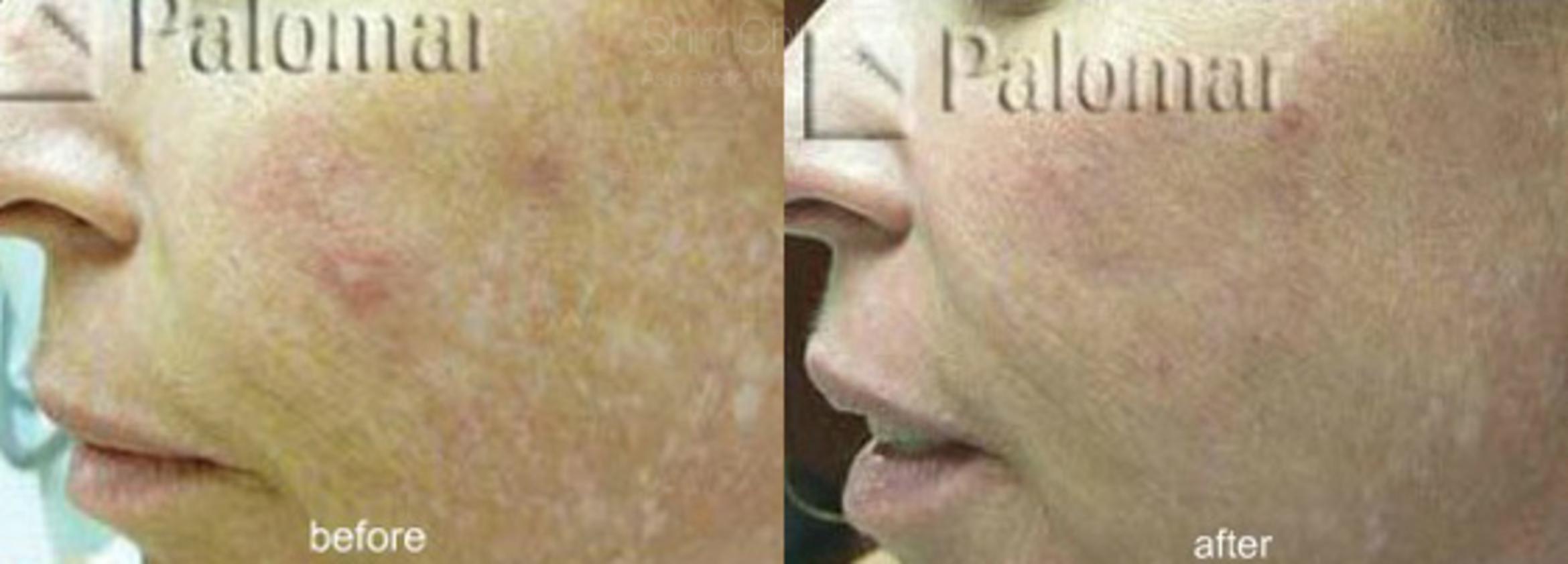 Laser Resurfacing Case 139 Before & After View #1 | Honolulu, HI | Shim Ching, MD: Asia Pacific Plastic Surgery