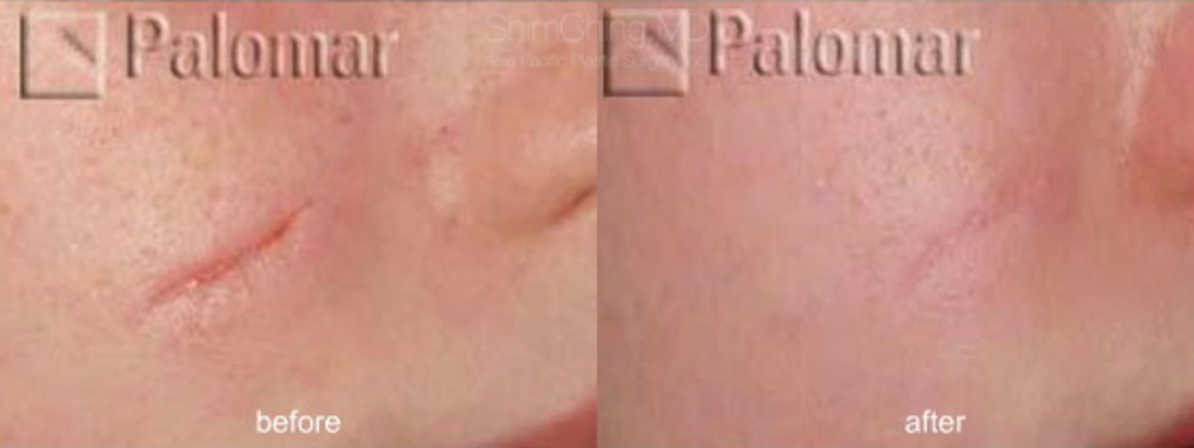 Laser Resurfacing Case 140 Before & After View #1 | Honolulu, HI | Shim Ching, MD: Asia Pacific Plastic Surgery