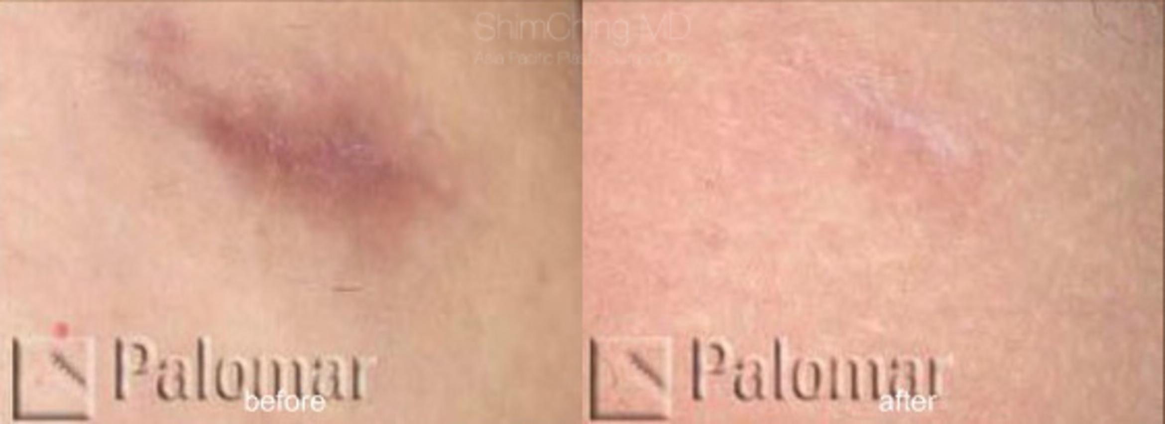 Laser Resurfacing Case 141 Before & After View #1 | Honolulu, HI | Shim Ching, MD: Asia Pacific Plastic Surgery