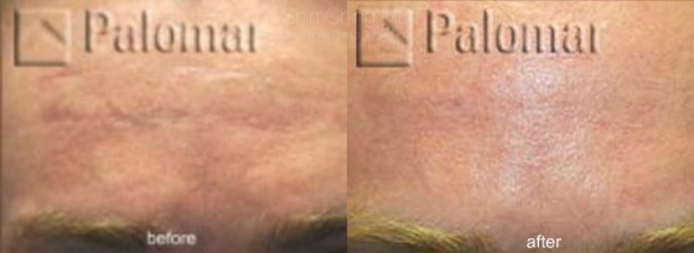 Laser Resurfacing Case 144 Before & After View #1 | Honolulu, HI | Shim Ching, MD: Asia Pacific Plastic Surgery