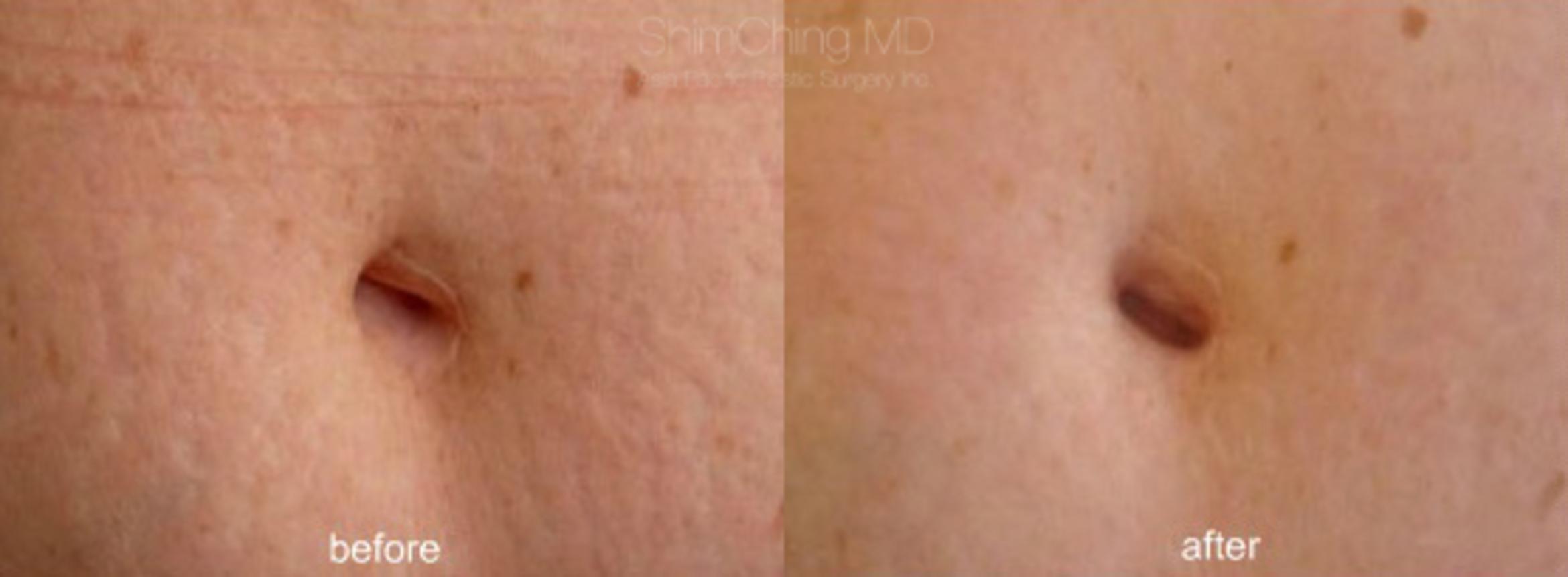 Laser Resurfacing Case 192 Before & After View #1 | Honolulu, HI | Shim Ching, MD: Asia Pacific Plastic Surgery
