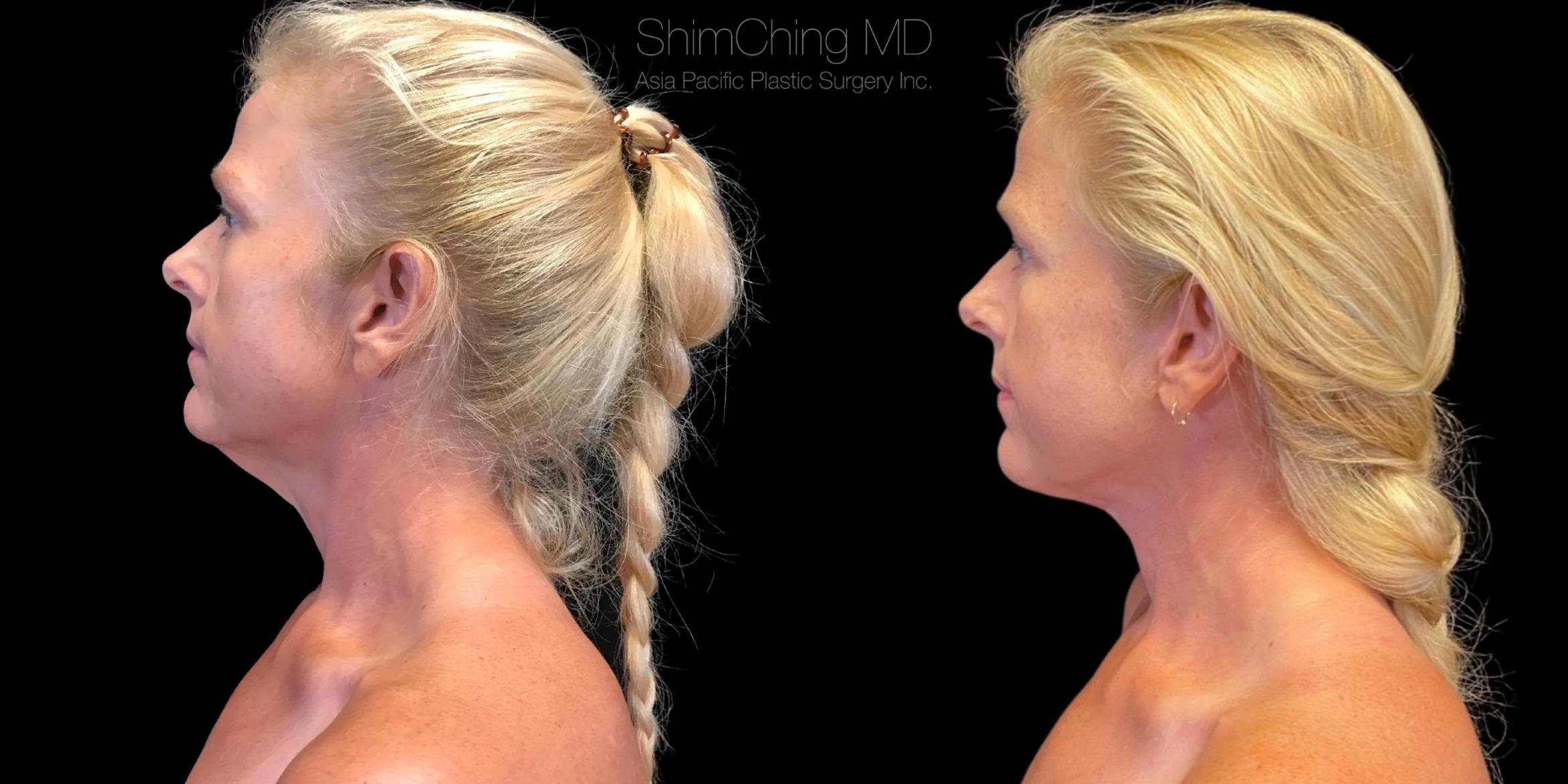 Necklift Case 272 Before & After Right Side | Honolulu, HI | Shim Ching, MD: Asia Pacific Plastic Surgery
