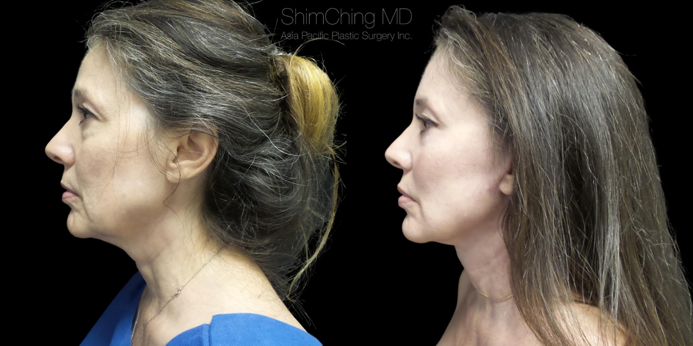 Necklift Case 274 Before & After Right Side | Honolulu, HI | Shim Ching, MD: Asia Pacific Plastic Surgery