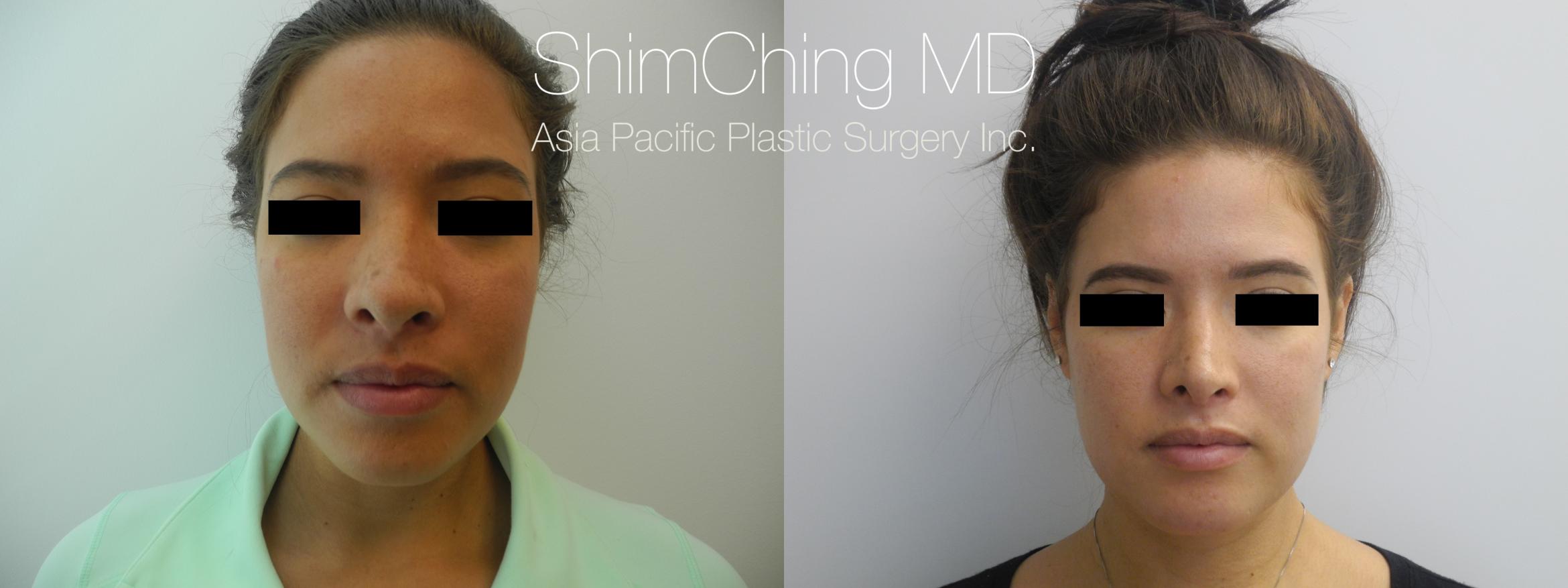 Rhinoplasty Case 222 Before & After View #1 | Honolulu, HI | Shim Ching, MD: Asia Pacific Plastic Surgery
