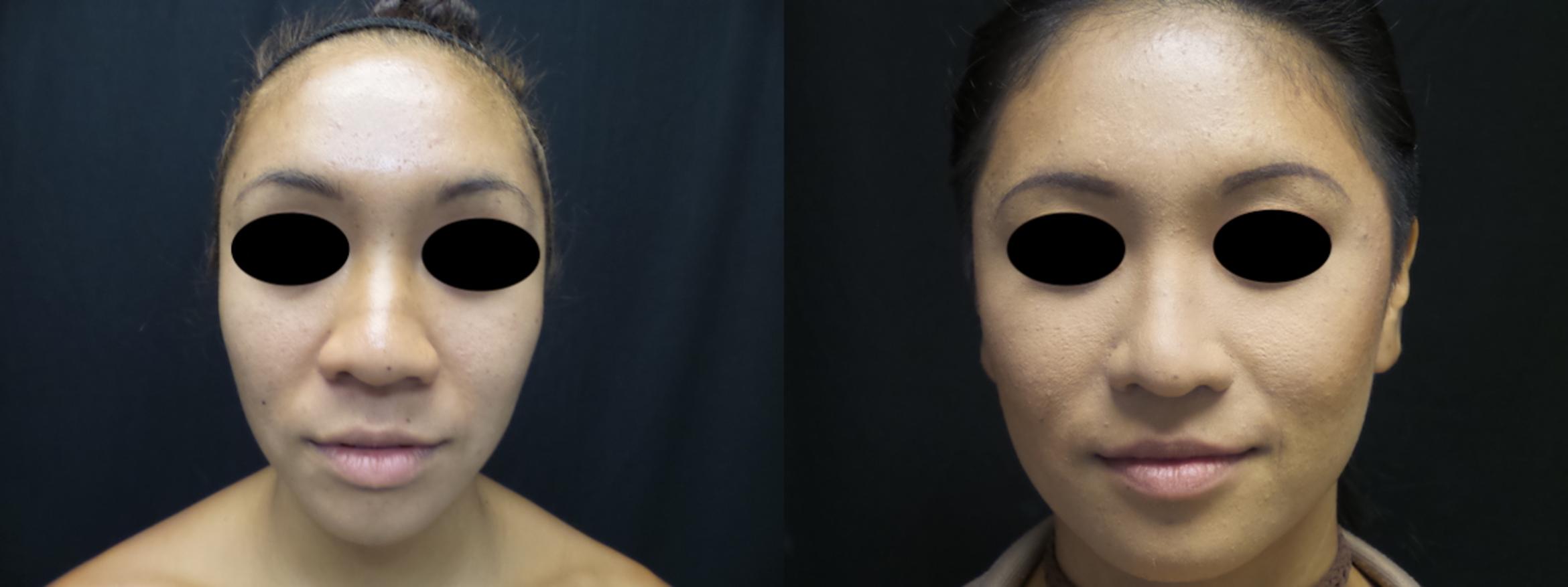 Rhinoplasty Case 33 Before & After View #1 | Honolulu, HI | Shim Ching, MD: Asia Pacific Plastic Surgery