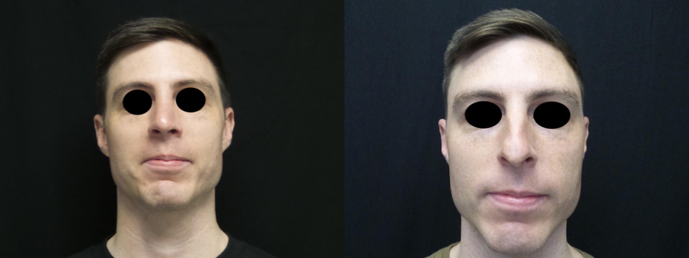 Rhinoplasty Case 34 Before & After View #1 | Honolulu, HI | Shim Ching, MD: Asia Pacific Plastic Surgery