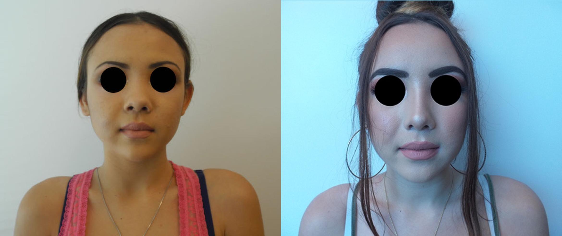 Rhinoplasty Case 35 Before & After View #1 | Honolulu, HI | Shim Ching, MD: Asia Pacific Plastic Surgery