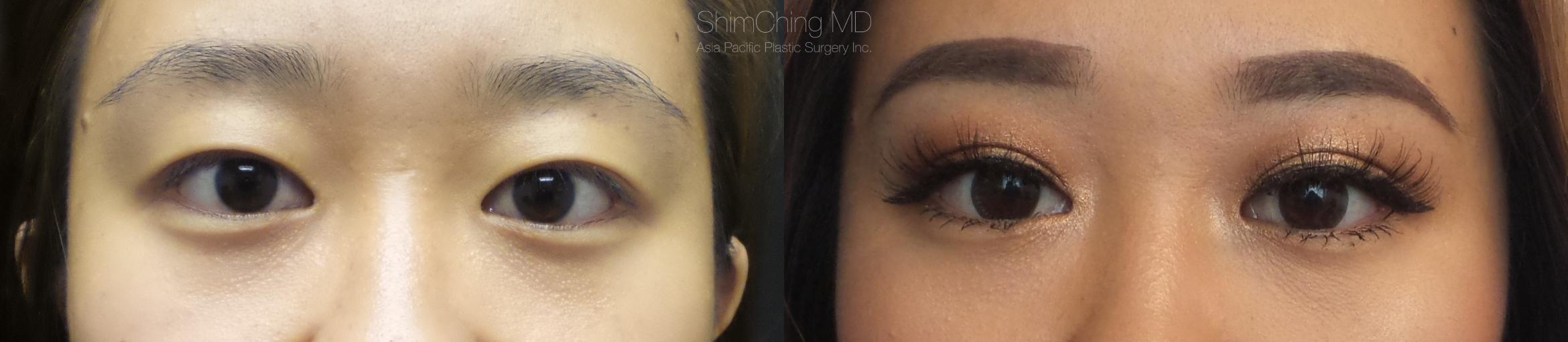 asian eyelid surgery before and after pictures